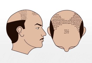 4000-7000 Grafts